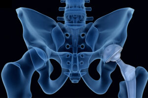 What is Pelvic Floor Dysfunction and how to treat it