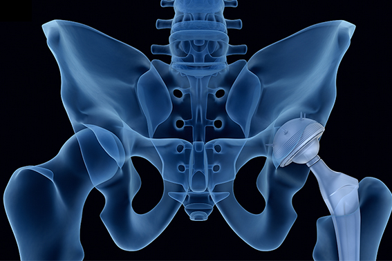 What is Pelvic Floor Dysfunction and how to treat it